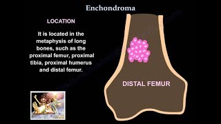 Enchondroma  Everything You Need To Know  Dr Nabil Ebraheim [upl. by Anwahsiek]