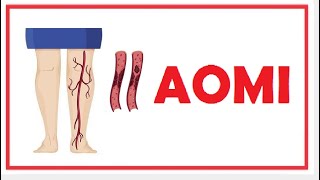 AOMI arteriopathie obliterante des membre inferieure [upl. by Mahmud]