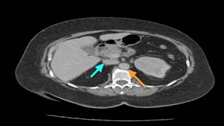 Clinical Case Renal Cell Carcinoma [upl. by Llewellyn611]