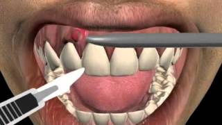 How to treat a tooth abscess [upl. by Fotinas]