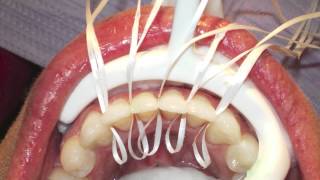 Retanium Splint Placement Orthodontics [upl. by Artemed]