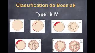 Diverticulite Sintomas e Tratamentos  Você Bonita 160418 [upl. by Luigino]