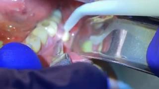 Draining a Dental Abscess  Advanced Dental Care [upl. by Atnuahc]