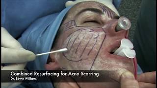 Laser amp Dermabrasion Treatment for Acne Scarring by Dr Edwin Williams [upl. by Nodnelg]