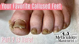 Extremely Callused Feet How to Pedicure  Left Foot [upl. by Stempien614]