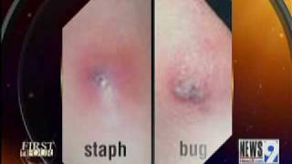 Bug Bites vs Staph Infections [upl. by Aker908]