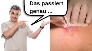 Infizierte Talgzyste Dermatologe zeigt die Eröffnung des Abszess und erläutert die Ursachen [upl. by Onra]