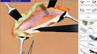 Hernia Repair  Open Surgery Simulation [upl. by Carlye]