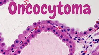 ACUTE TUBULAR INJURYNECROSIS or ACUTE KIDNEY INJURY  Pathology [upl. by Schlicher783]