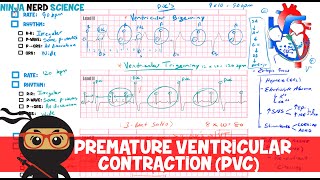 Rate and Rhythm  Premature Ventricular Contraction PVC [upl. by Jaret]