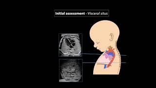 Heart Blocks Anatomy and ECG Reading Animation [upl. by Bernstein]