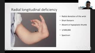 Congenital deformities of the Upper Limb [upl. by Nodla105]