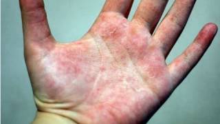 DermTV  How to Treat Eczema DermTVcom Epi 178 [upl. by Egarton]