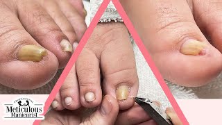 Ingrown Toenail Pedicure [upl. by Suoirtemed]