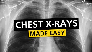 Chest X Rays CXR Made Easy  Learn in 10 Minutes [upl. by Dyl677]