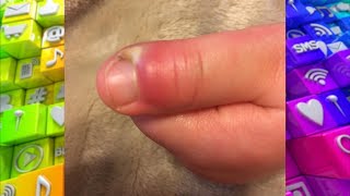 How to Spot an Infection around the Nail [upl. by Nnaear184]