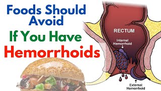 9 Foods That Make Hemorrhoids Worse  Foods To Avoid For Hemorrhoids [upl. by Newsom]