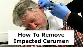 Removing Impacted Cerumen from a Patients Ear [upl. by Em]