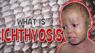 What is Ichthyosis  Cause Symptoms amp Treatment [upl. by Rosenstein362]