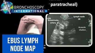 EBUS Lymph Node Map  Nodal Anatomy [upl. by Naved]