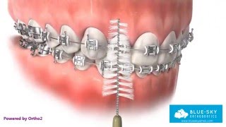 Oral Hygiene with Braces [upl. by Doner]