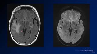 Imaging brain tumors  5  Non glial tumors [upl. by Anaed]