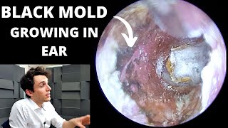 Black Mold Growing In Ear Canal Aspergillus Niger Fungus Extraction [upl. by Ajit]