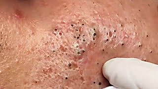 So Scary  Removal Of Deep Blackheads On Man Face [upl. by Bilbe]