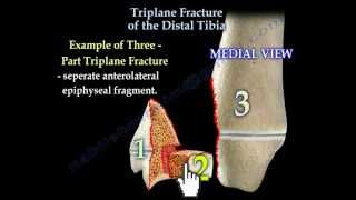 Triplane Fracture Of The Distal Tibia  Everything You Need To Know  Dr Nabil Ebraheim [upl. by Aratal932]