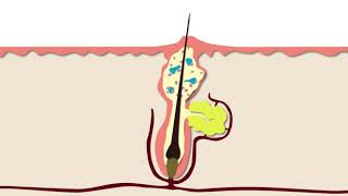 How Acne Develops  Acne Support [upl. by Colligan]