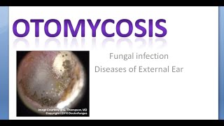 ENT OtoMycosis Fungal Infection Ear [upl. by Eillat]