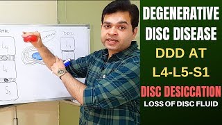 Degenerative Disc Disease DDD L4 L5 L5 S1Disc Desiccation Disc Degeneration Disease Treatment [upl. by Anilegnave904]