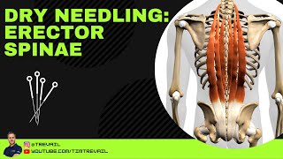 Dry Needling Erector Spinae [upl. by Hannad]