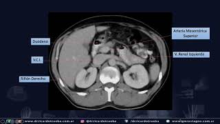 TOMOGRAFIA AXIAL BASICA DE ABDOMEN Y PELVIS [upl. by Sutsugua]