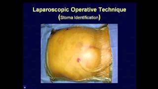 Parastomal Hernia Repair � Best Techniques Kristi Harold MD [upl. by Susejedairam]