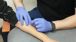 Dry Needling for Tennis Elbow [upl. by Eugor]