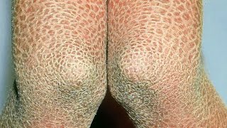 quotFish Skinquot Ichthyosis Dr John Gilmores Treatment Video [upl. by Burck]