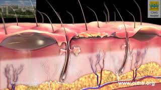 Burns  Classification and Treatment [upl. by Arimahs37]