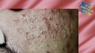 Retirando Cravos Pretos na testa  Acne treatment  Vídeo Satisfatório 062 [upl. by Maloney582]