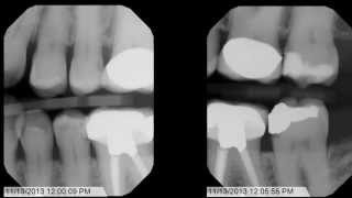 Tips and Tricks for Bitewing XRays [upl. by Ailalue]