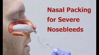 Nasal Packing for Severe Nosebleeds [upl. by Sammy118]