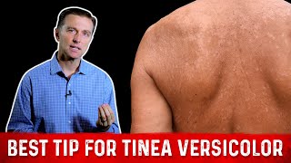 Tinea Versicolor  Daily Dos of Dermatology [upl. by Hellah274]