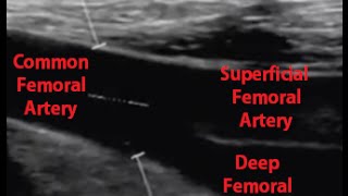 Femoral Artery Ultrasound [upl. by Giule479]