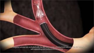 Endobronchial Valve Animation  SPIRATION [upl. by Kuehn]