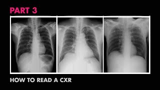 How XRays Work  How to Read a Chest XRay Part 3  MEDZCOOL [upl. by Broida]