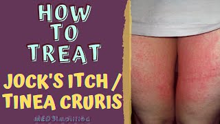 HOW TO TREAT JOCKS ITCH  TINEA CRURIS [upl. by Notsuoh]