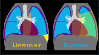 Pleural Effusion Explained by Prometheus Lionhart MD [upl. by Gasperoni]