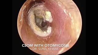 Otomycosis with CSOM  Fungus in ear with perforated Tympanic Membrane [upl. by Adnawuj]