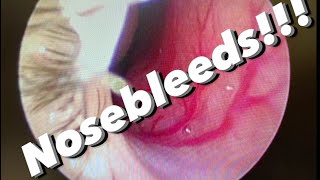 Nosebleeds epistaxis causes prevention treatments and more [upl. by Eelamme]