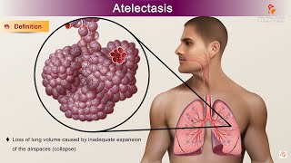 Atelectasis  Etiology Clinical Features Pathology pathophysiology Diagnosis and Treatment [upl. by Drusie]